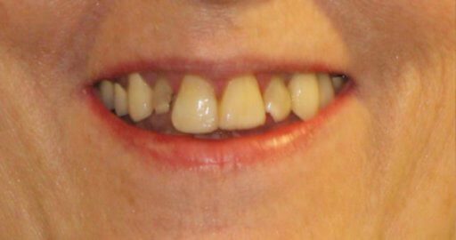 Teeth-4-Before