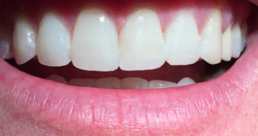 Teeth-5-After