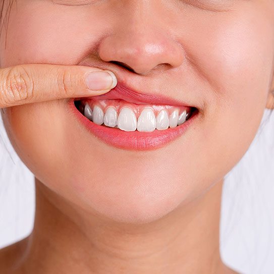 gum recession 2024 543 - Lombardo & Cho Dentistry
