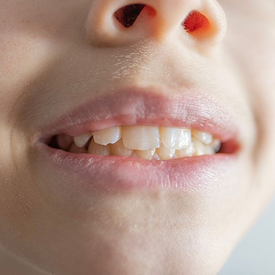 child gum disease 2024 543 1 - Lombardo & Cho Dentistry