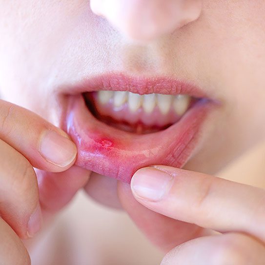 canker sore 2025 543 1 - Lombardo & Cho Dentistry