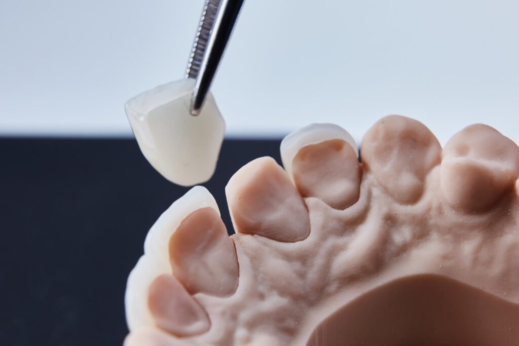 porcelain veneers