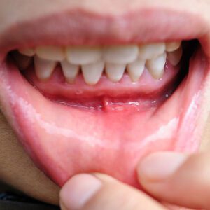 gum recession 2026 543 - Lombardo & Cho Dentistry